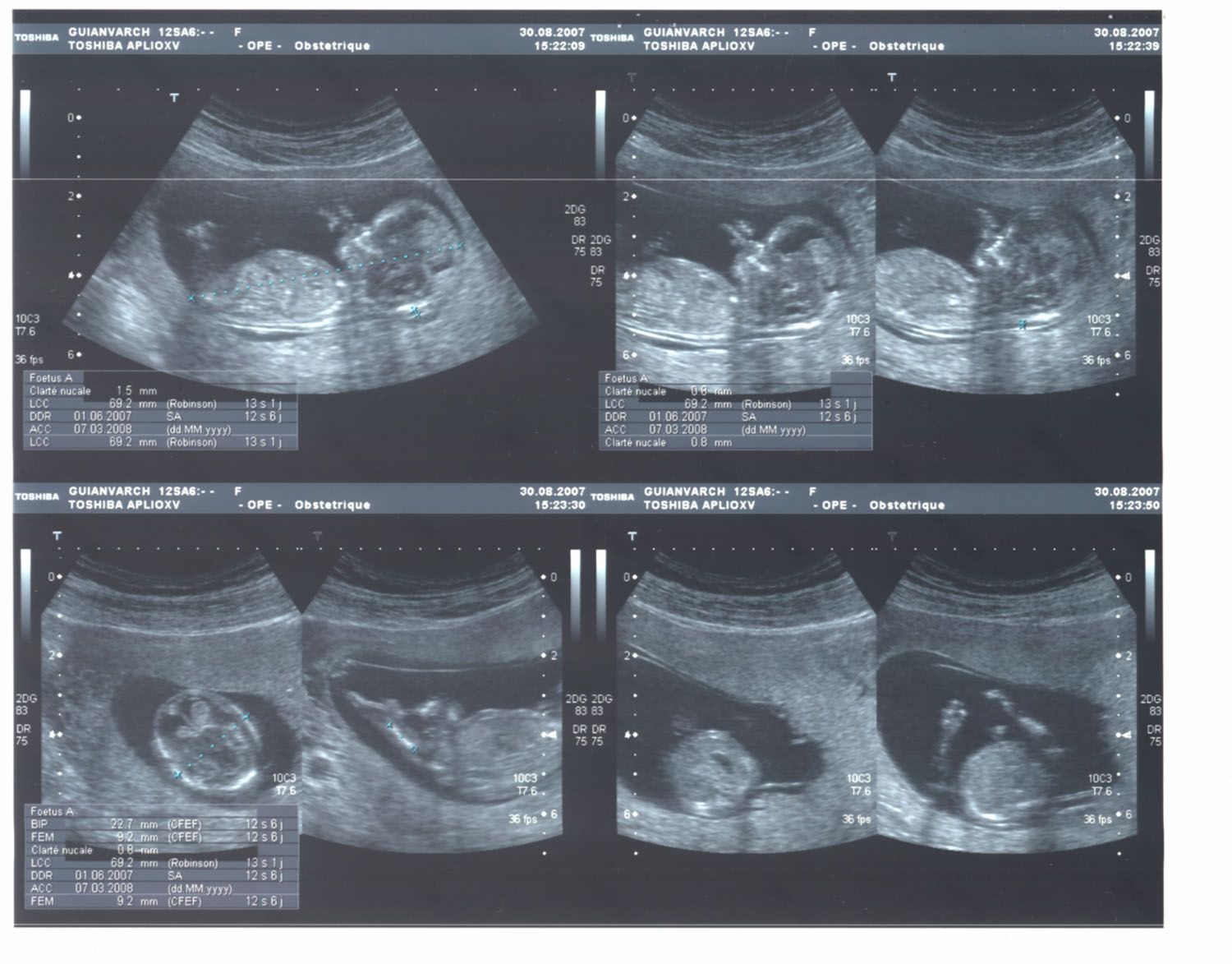 Echo du troisieme mois echographie fille 5 mois